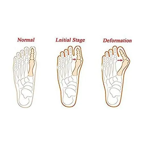 Bunion Splint Wrap - Corrector Brace ~ Big Toe Straightener